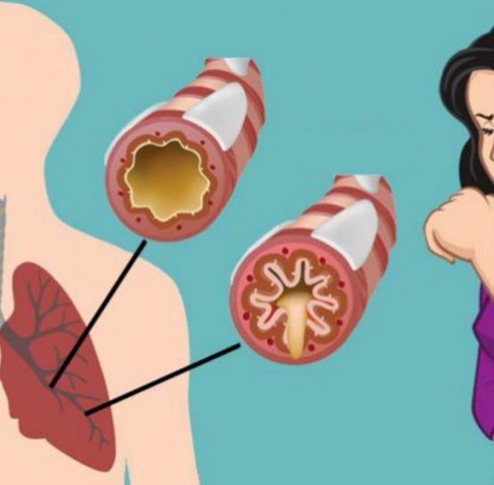 Как устранить слизь и мокроту из горла и груди (мгновенный результат)