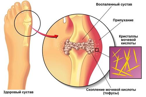 Особенности питания при подагре