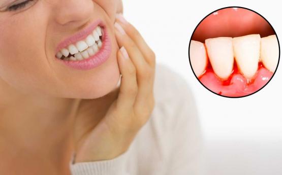 Եթե լնդերից կամ ատամները լվանալիս արյուն է գալիս, ձեզ մոտ առկա է առողջական այս խնդիրը