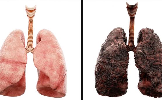 Ընդամենը 4 օրում մաքրեք թոքերը նիկոտինից, մանրէներից և թունավոր ու վտանգավոր նյութերից