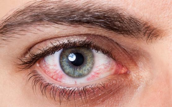 Ինչ հիվանդության նշան է աչքերի կարմրածությունը․ Աչքաթող մի արեք դա