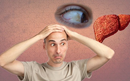 Ի՞նչ է լյարդի ցիռոզը, որոնք են ախտանշանները և առաջացման պատճառները