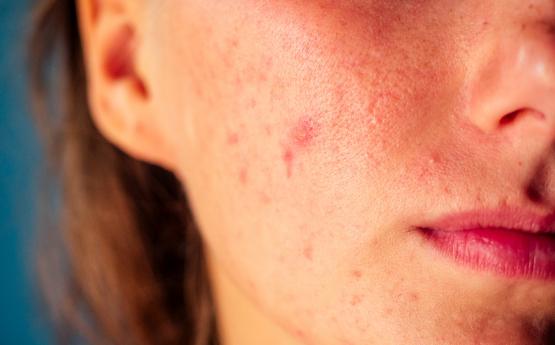 Եթե դեմքի մաշկի հետ կապված խնդիրներ ունեք, դա վկայում է այս հիվանդության մասին 