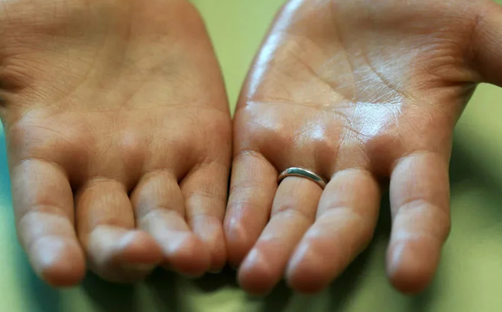 Ի՞նչ հիվանդության նշան է, երբ ձեռքերը քրտնում են