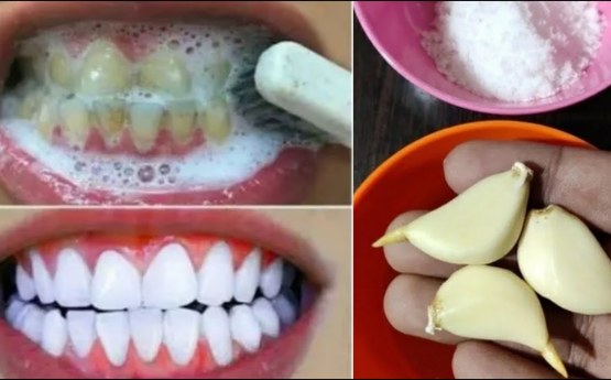 Բնական միջոց, որը կսպիտակեցնի և կփայլեցնի ձեր ատամները ՝ առաջին իսկ օգտագործելուց հետո