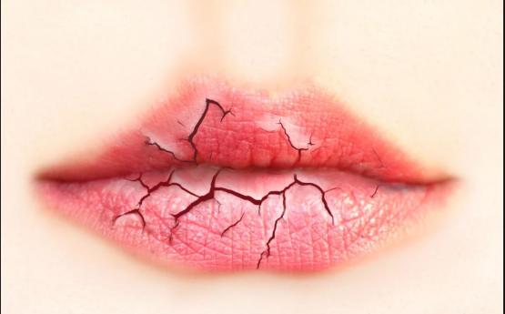 Եթե շրթունքները չորանում են կամ բերանի հատվածում ճաքեր են առաջանում, ուրեմն ունեք այս առողջական խնդիրը