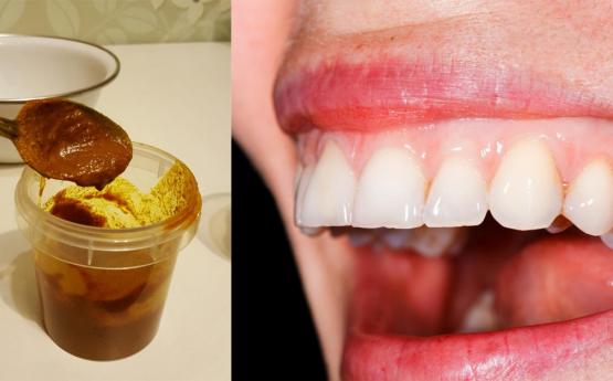 Ատամնաբույժները շուտով անգործ կմնան․ Սա քսեք ատամներին և այն կվերացնի կարիեսն ու կսպիտակեցնի ատամները