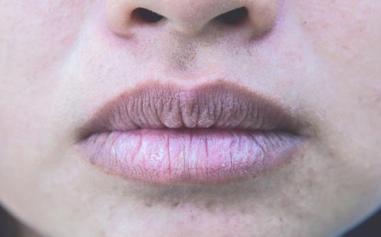 Ինչ վիտամինի պակաս ունեք, եթե ձեր շուրթերը գունատ են