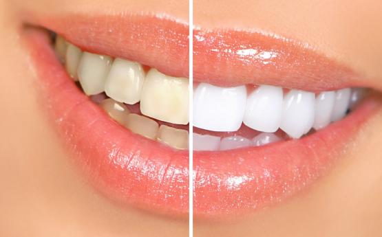 Սպիտակեցրեք արդեն իսկ դեղնած ատամների էմալը․ Ձեզ այդ հարցում կօգնի աղն ու սոդան