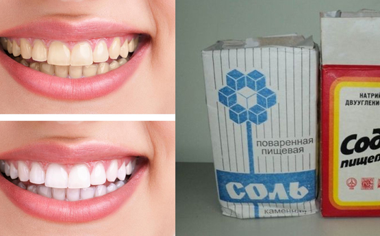 Ինչպե՞ս սոդայի և աղի միջոցով վերացնել ատամնաքարերը առանց ցավի և առանց ատամնաբուժարան այցի